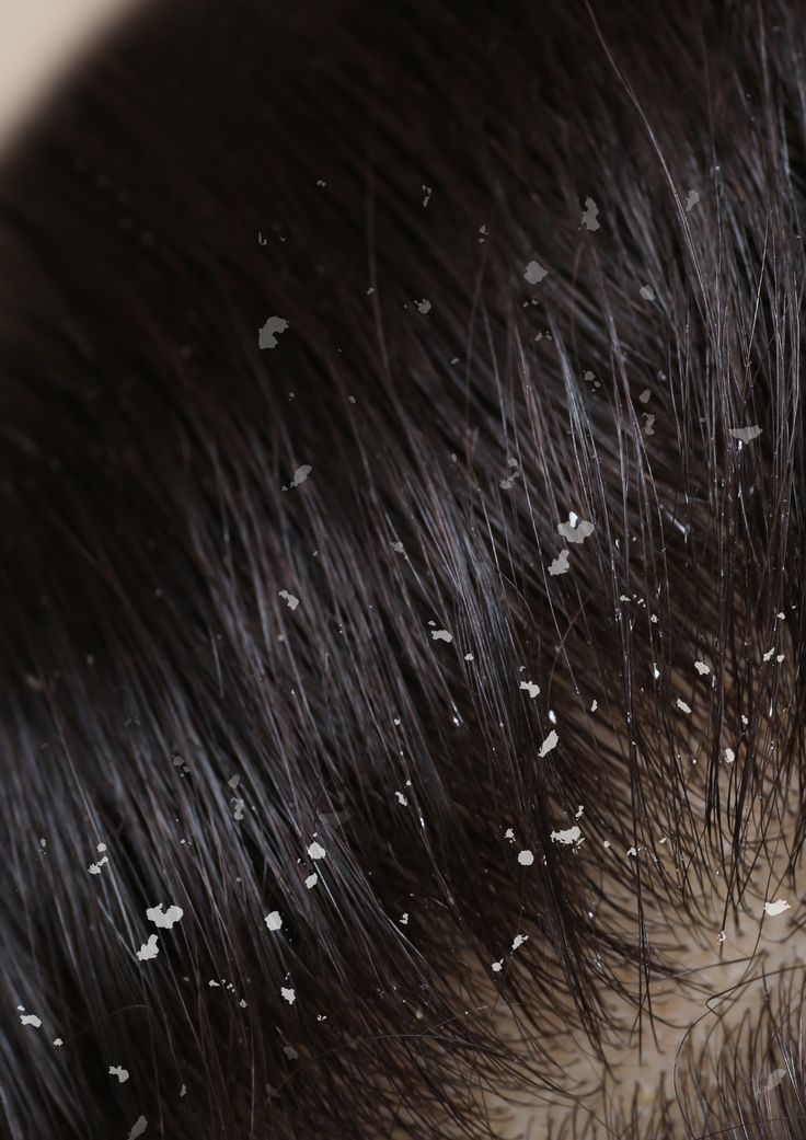 Dandruff & Flaky Scalp